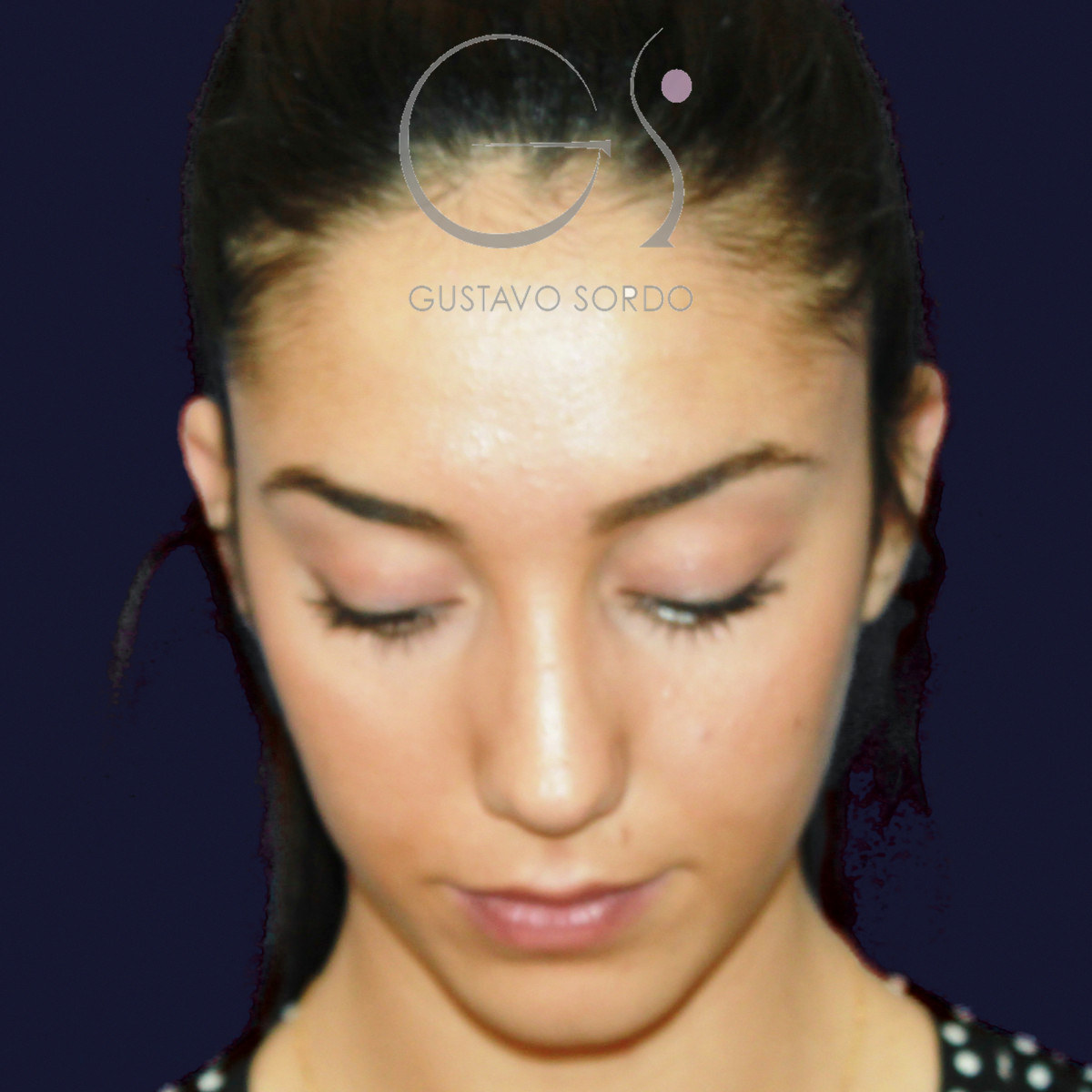 Antes de rinoplastia en nariz ancha con dorso en V, vista frontal con el mentón abajo