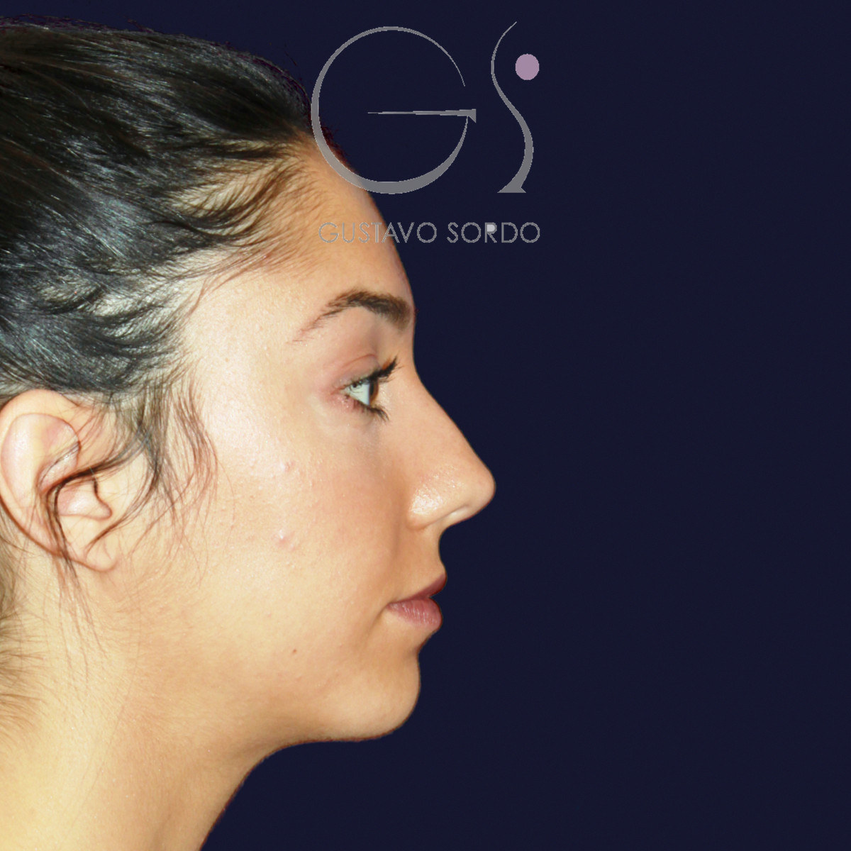 Antes de rinoplastia en nariz ancha con dorso en V, vista de perfil derecho