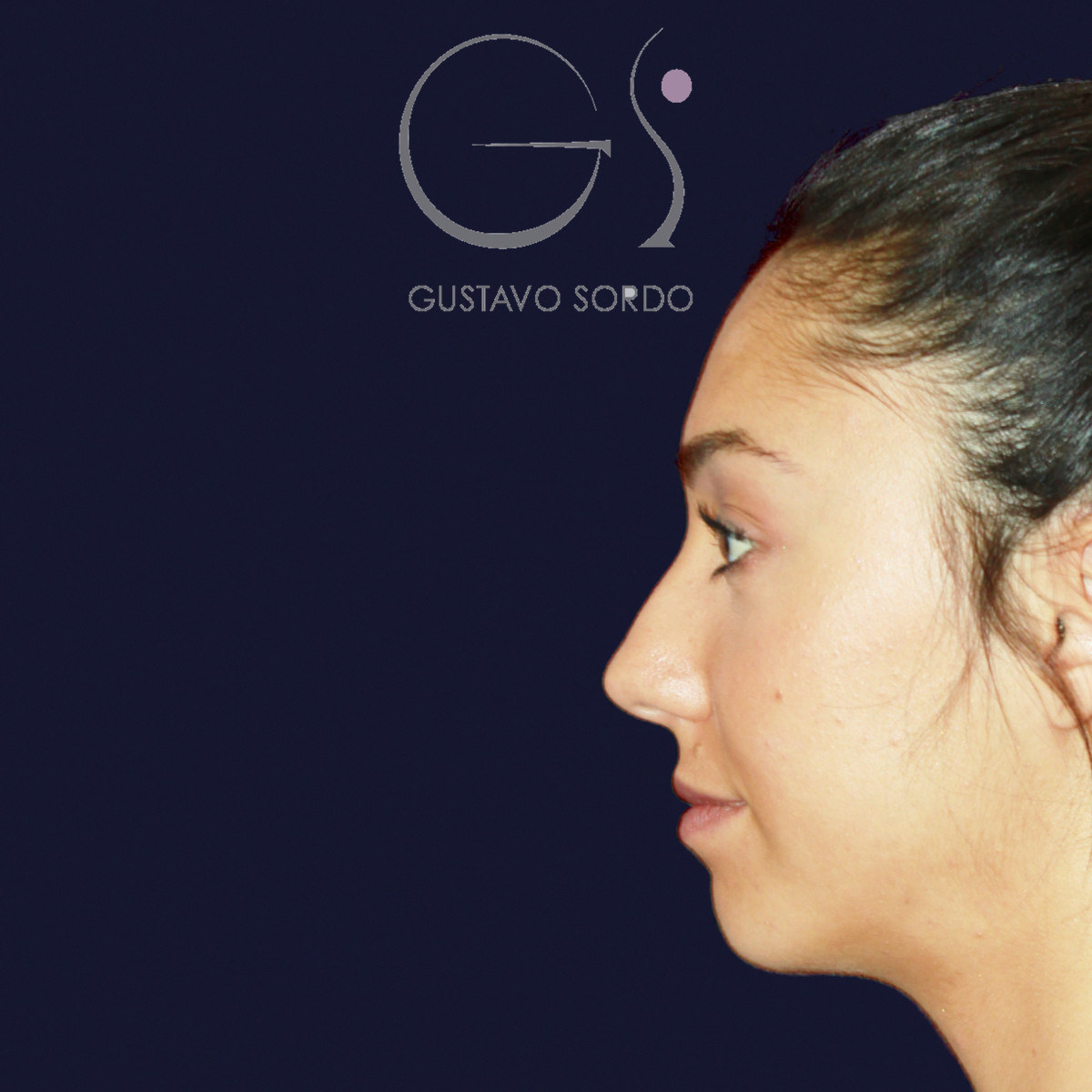 Antes de rinoplastia en nariz ancha con dorso en V, vista de perfil izquierdo
