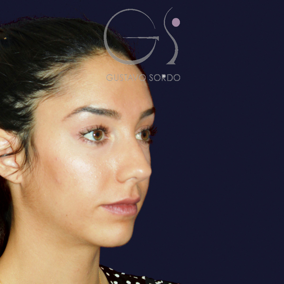 Antes de rinoplastia en nariz ancha con dorso en V, vista de semiperfil derecho