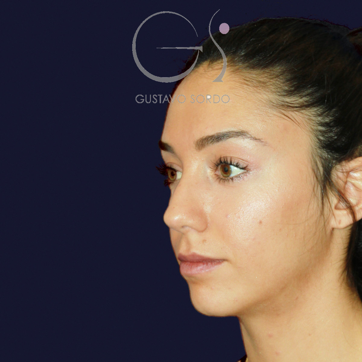 Antes de rinoplastia en nariz ancha con dorso en V, vista de semiperfil izquierdo
