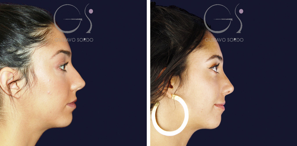 Rinoplastia en nariz ancha con dorso en V: antes y a los 15 meses, perfil derecho