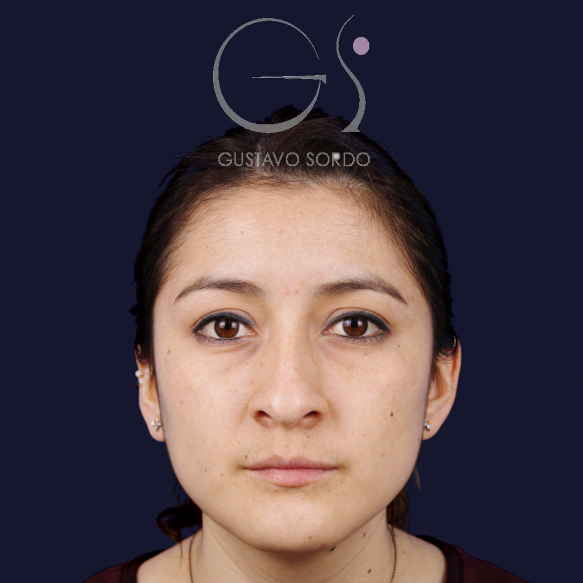 Before rhinoplasty on a wide nose with a hump, front view