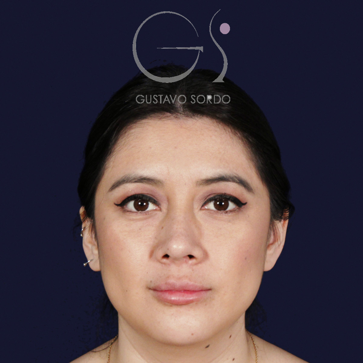 After rhinoplasty on a wide nose with a hump, at age six, front view