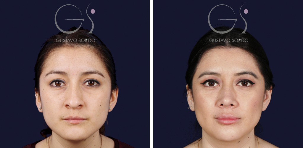 Rhinoplastie sur un nez large avec une bosse&nbsp;: avant, à six ans déjà, vue de face
