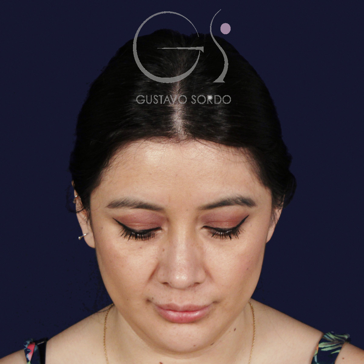 After rhinoplasty on a wide nose with a hump, at age six, front view with chin down