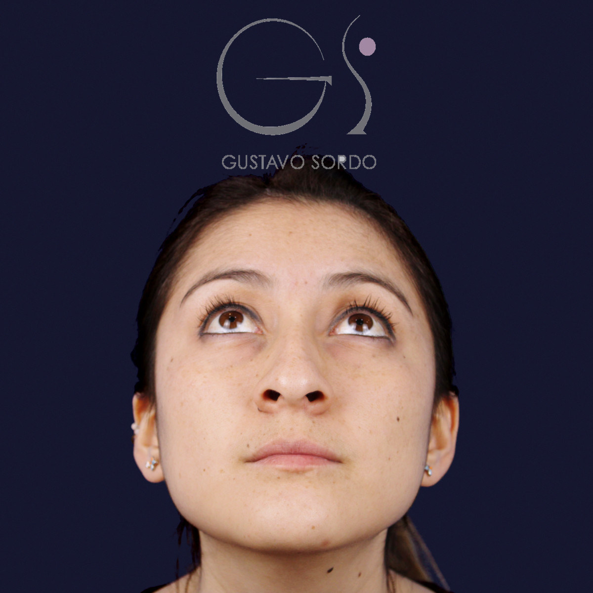 Before rhinoplasty on a wide nose with a hump, front view with the chin up
