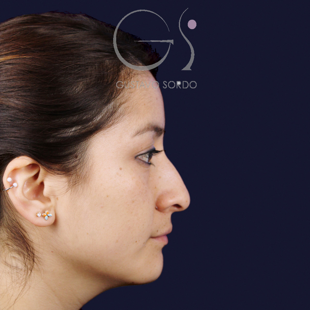 Before rhinoplasty on a wide nose with a hump, right profile view