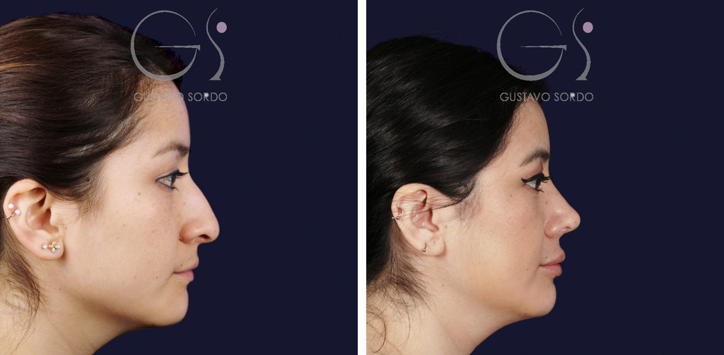 Rinoplastia en nariz ancha con giba: antes y a los seis años, perfil derecho