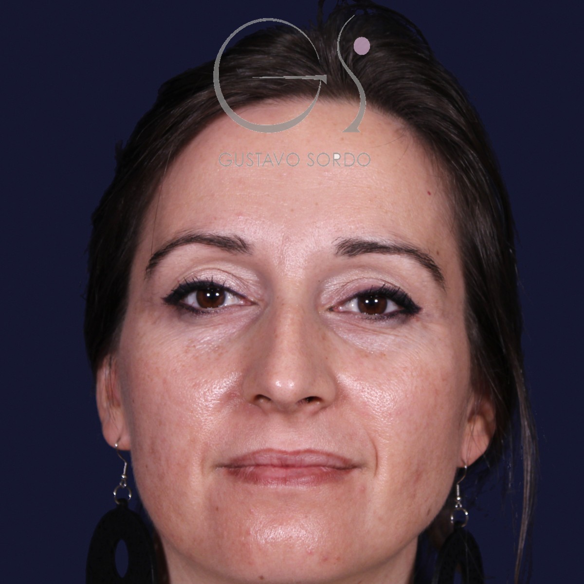 Antes de rinoplastia en nariz grande con caballete, vista frontal