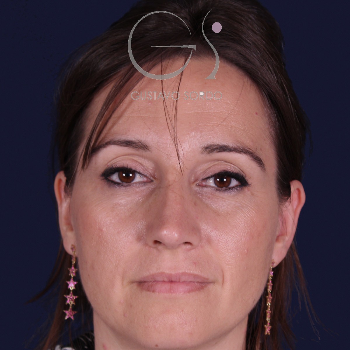 Después de rinoplastia en nariz grande con caballete, al año, vista frontal