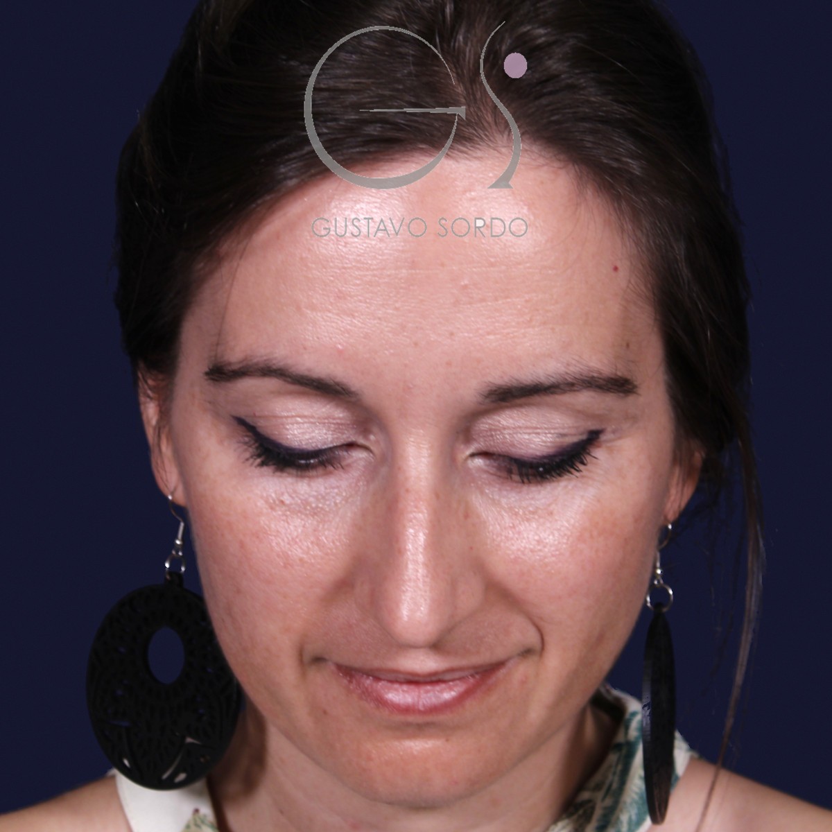 Antes de rinoplastia en nariz grande con caballete, vista frontal con el mentón abajo