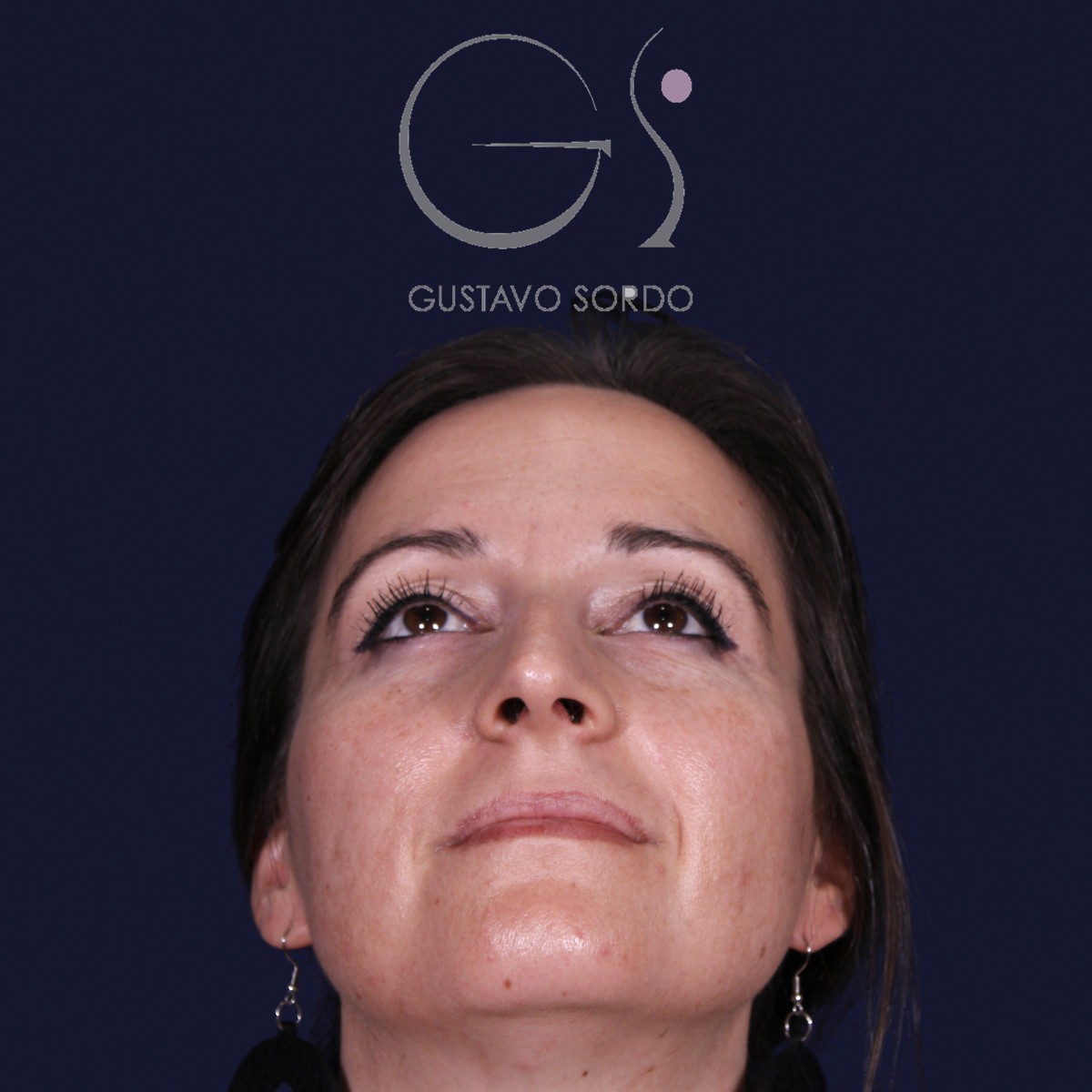 Antes de rinoplastia en nariz grande con caballete, vista frontal con el mentón arriba