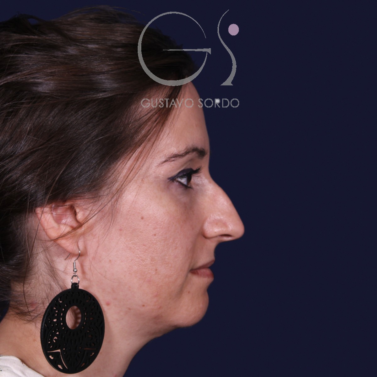 Antes de rinoplastia en nariz grande con caballete, vista de perfil derecho