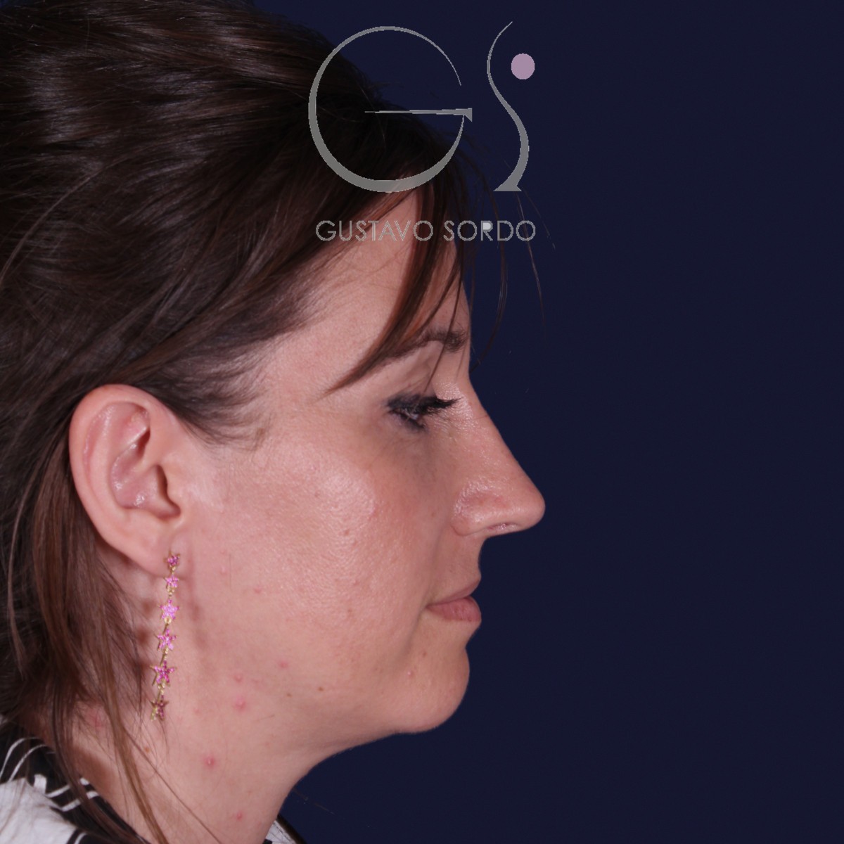 Después de rinoplastia en nariz grande con caballete, al año, vista de perfil derecho