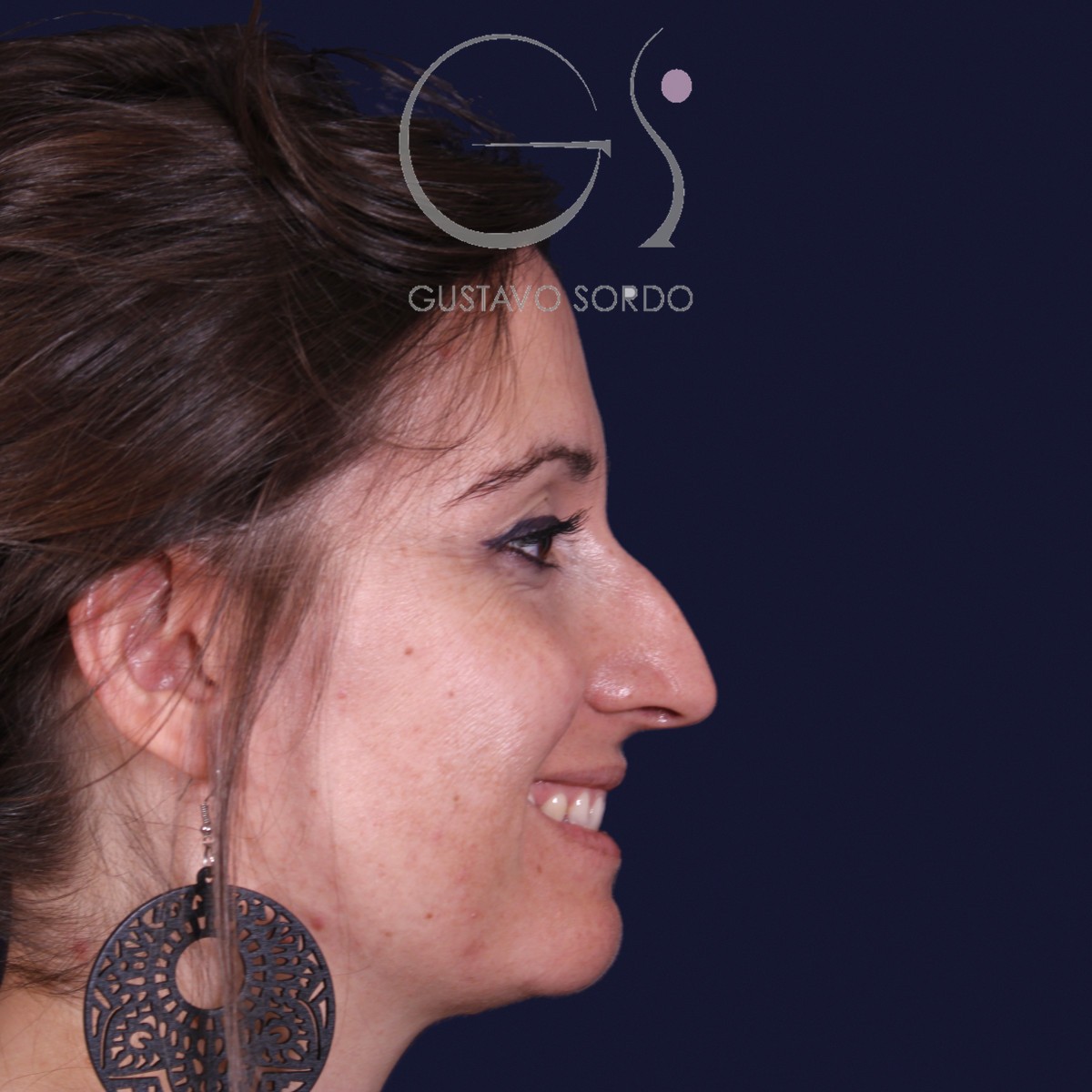 Antes de rinoplastia en nariz grande con caballete, vista de perfil derecho sonriendo