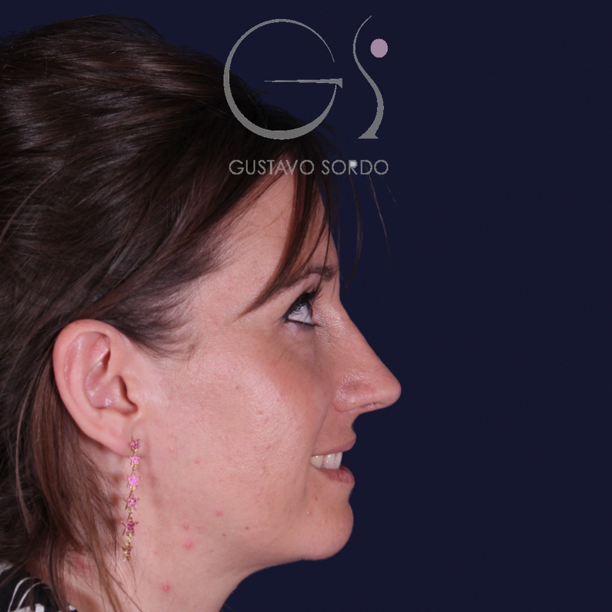 Después de rinoplastia en nariz grande con caballete, al año, vista de perfil derecho sonriendo