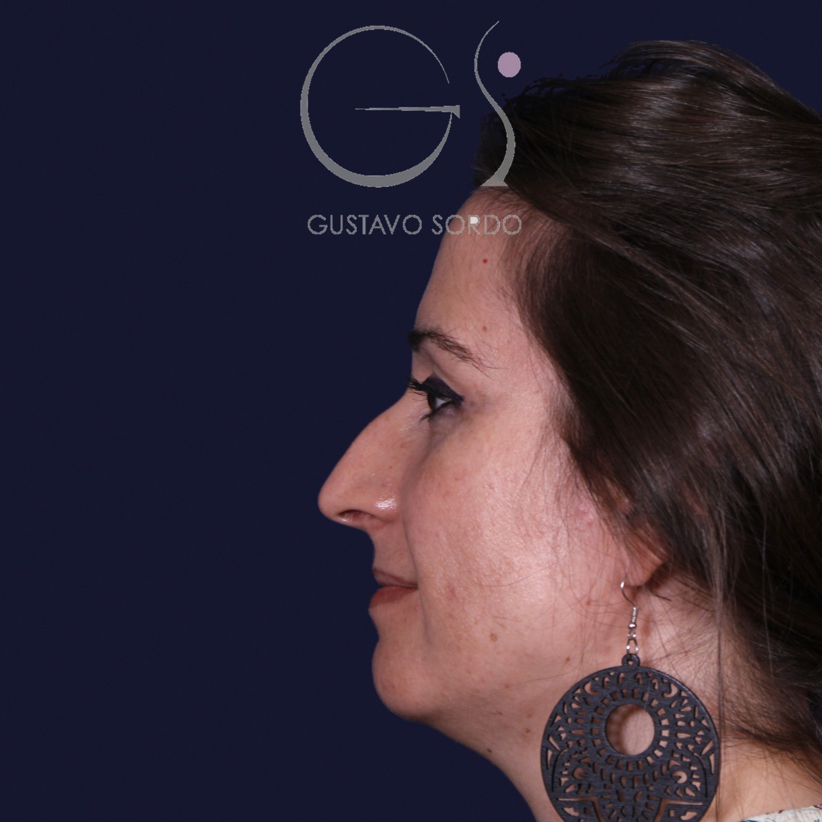 Antes de rinoplastia en nariz grande con caballete, vista de perfil izquierdo