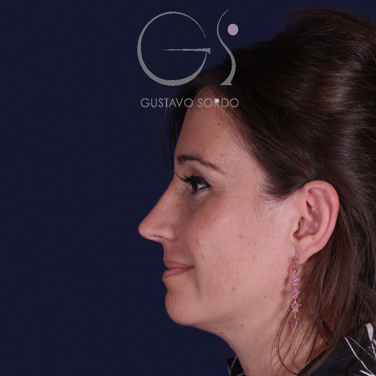 Después de rinoplastia en nariz grande con caballete, al año, vista de perfil izquierdo
