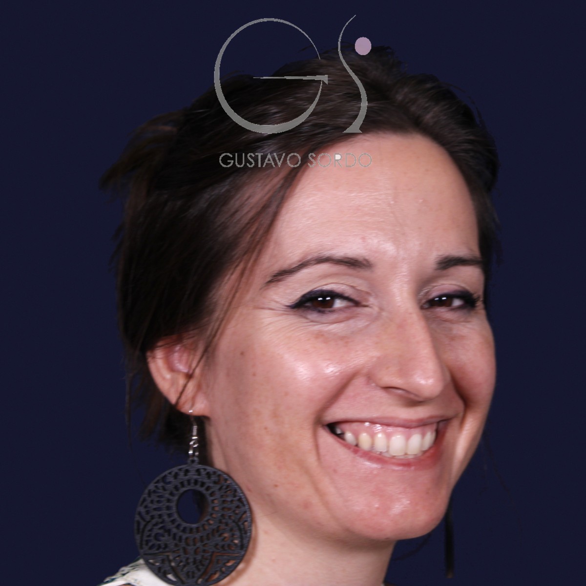 Antes de rinoplastia en nariz grande con caballete, vista de semiperfil derecho sonriendo