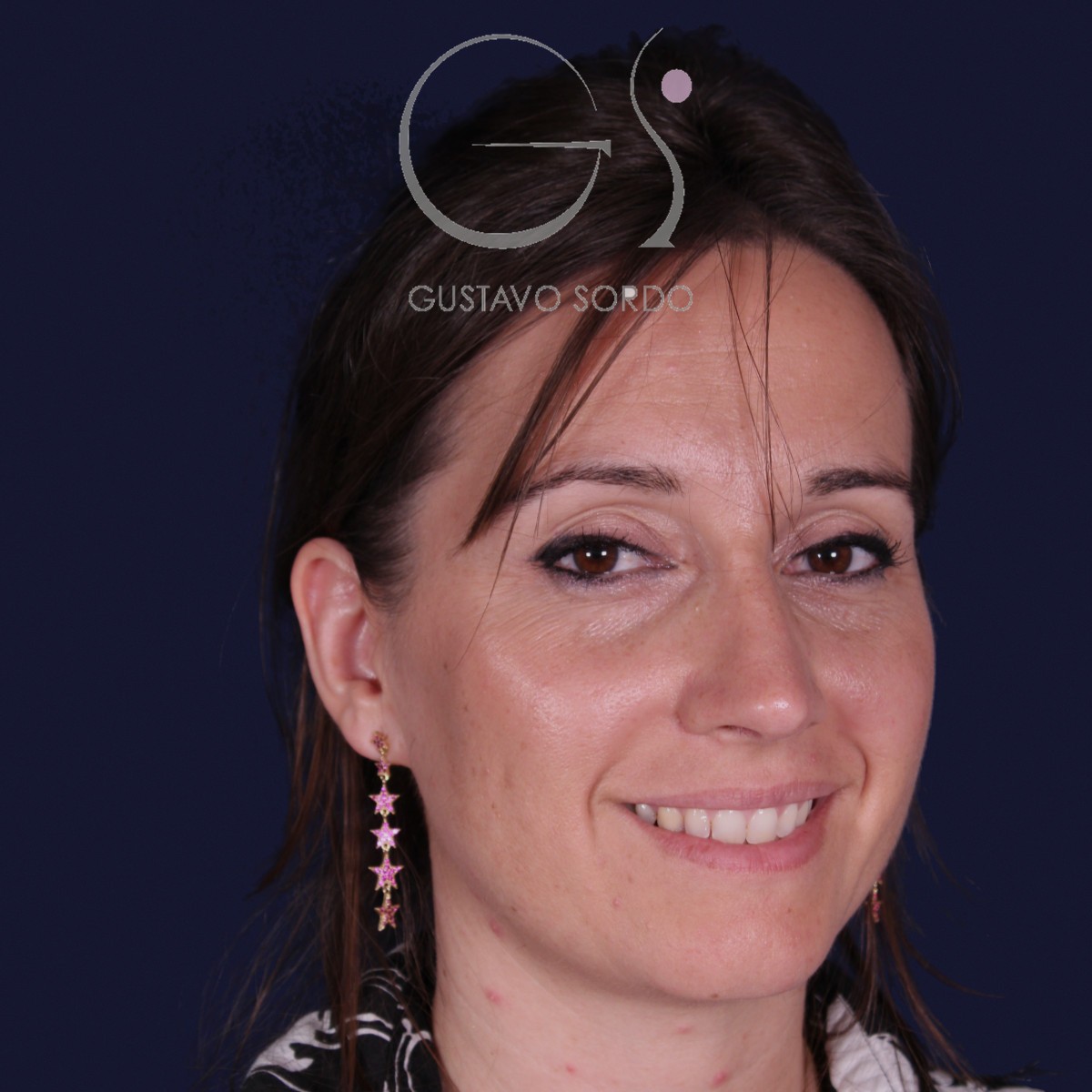 Después de rinoplastia en nariz grande con caballete, al año, vista de semiperfil derecho sonriendo