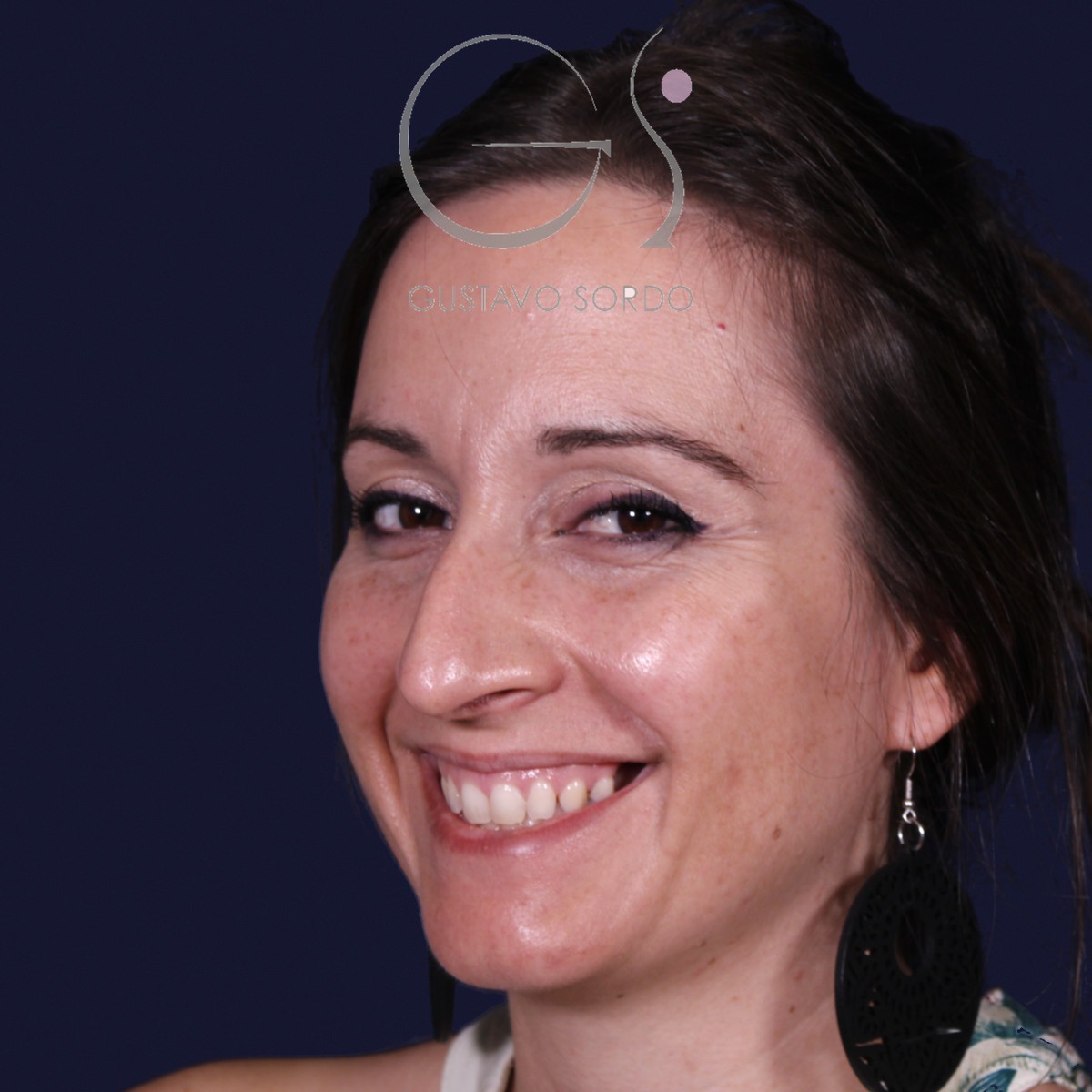 Antes de rinoplastia en nariz grande con caballete, vista de semiperfil izquierdo sonriendo