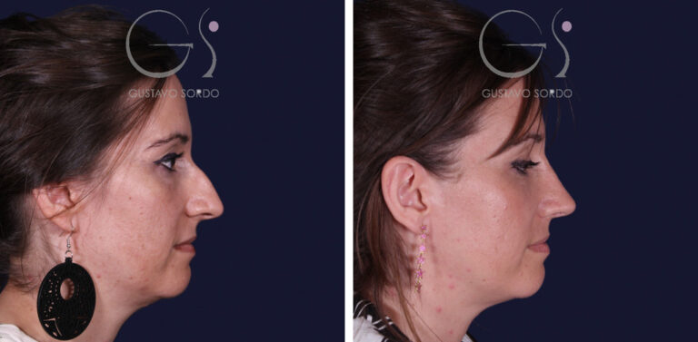 Rinoplastia en nariz grande con caballete: antes y al año, perfil derecho