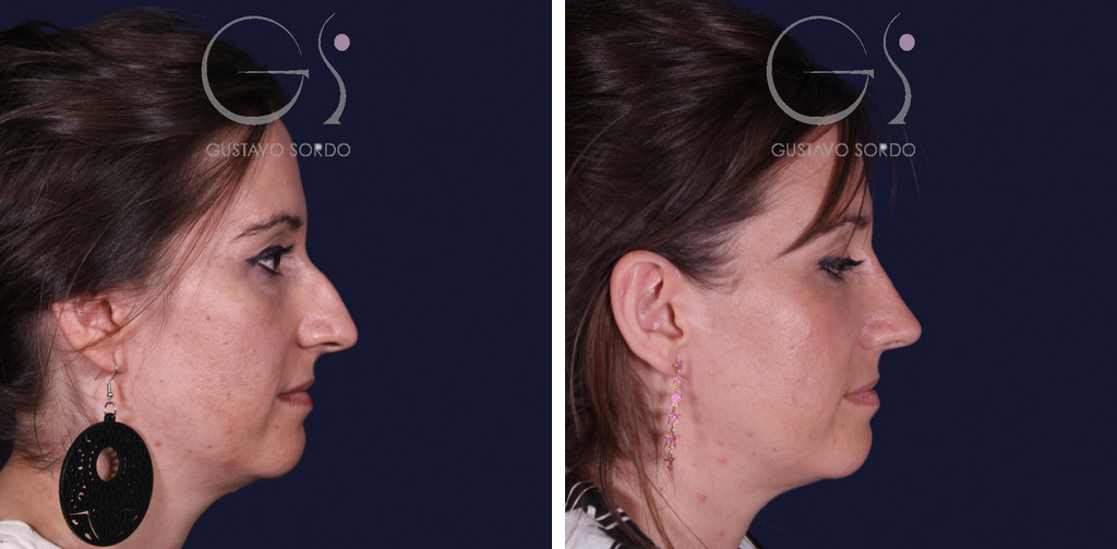 Rinoplastia en nariz grande con caballete: antes y al año, perfil derecho