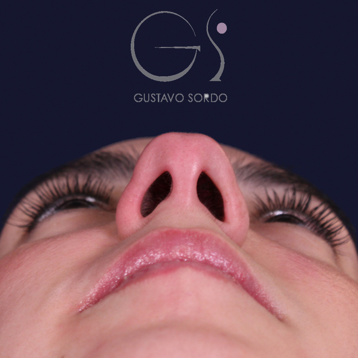 Rinoplastia estructural en piel gruesa con punta gruesa, vista basal: antes de la operación