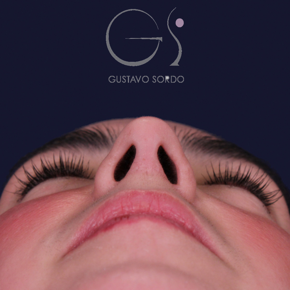Rinoplastia estructural en piel gruesa con punta gruesa, vista basal: resultado al año de la operación