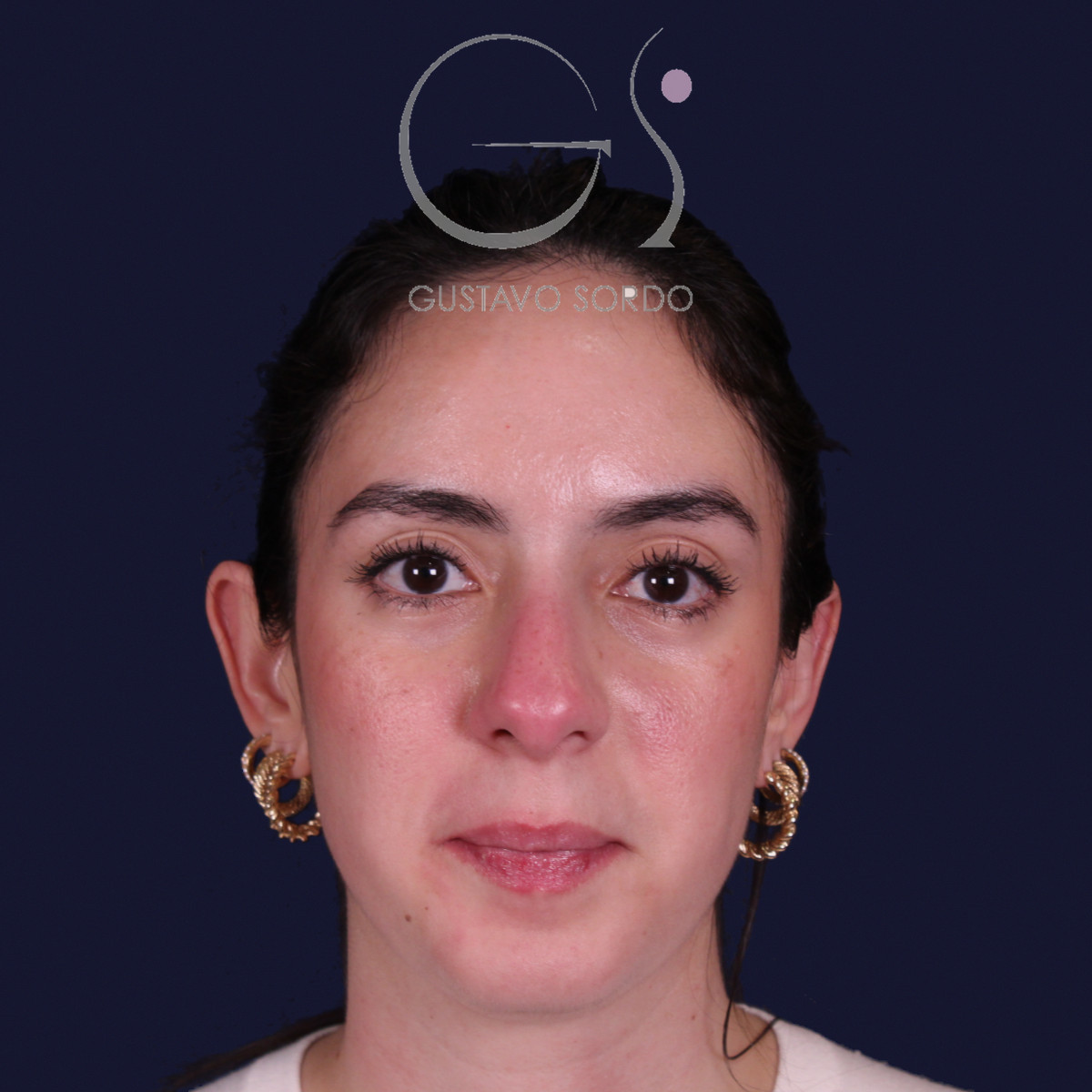 Rinoplastia estructural en piel gruesa con punta gruesa, vista frontal: antes de la operación