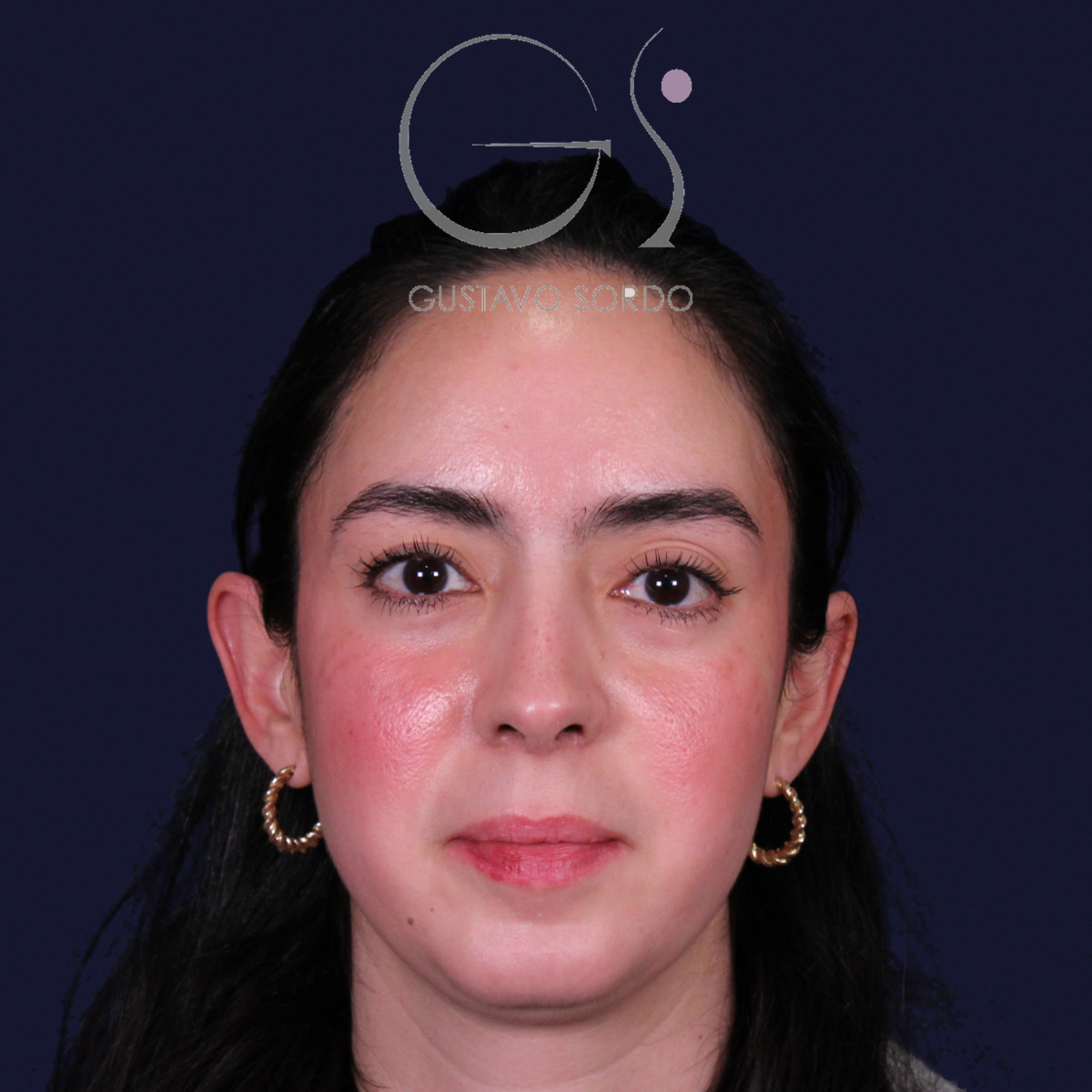 Rinoplastia estructural en piel gruesa con punta gruesa, vista frontal: resultado al año de la operación