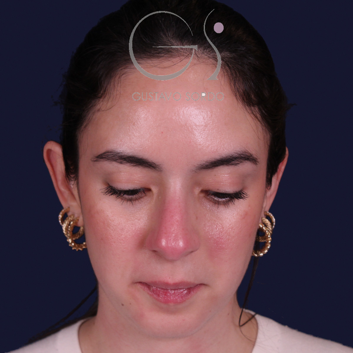 Rinoplastia estructural en piel gruesa con punta gruesa, vista con el mentón abajo: antes de la operación