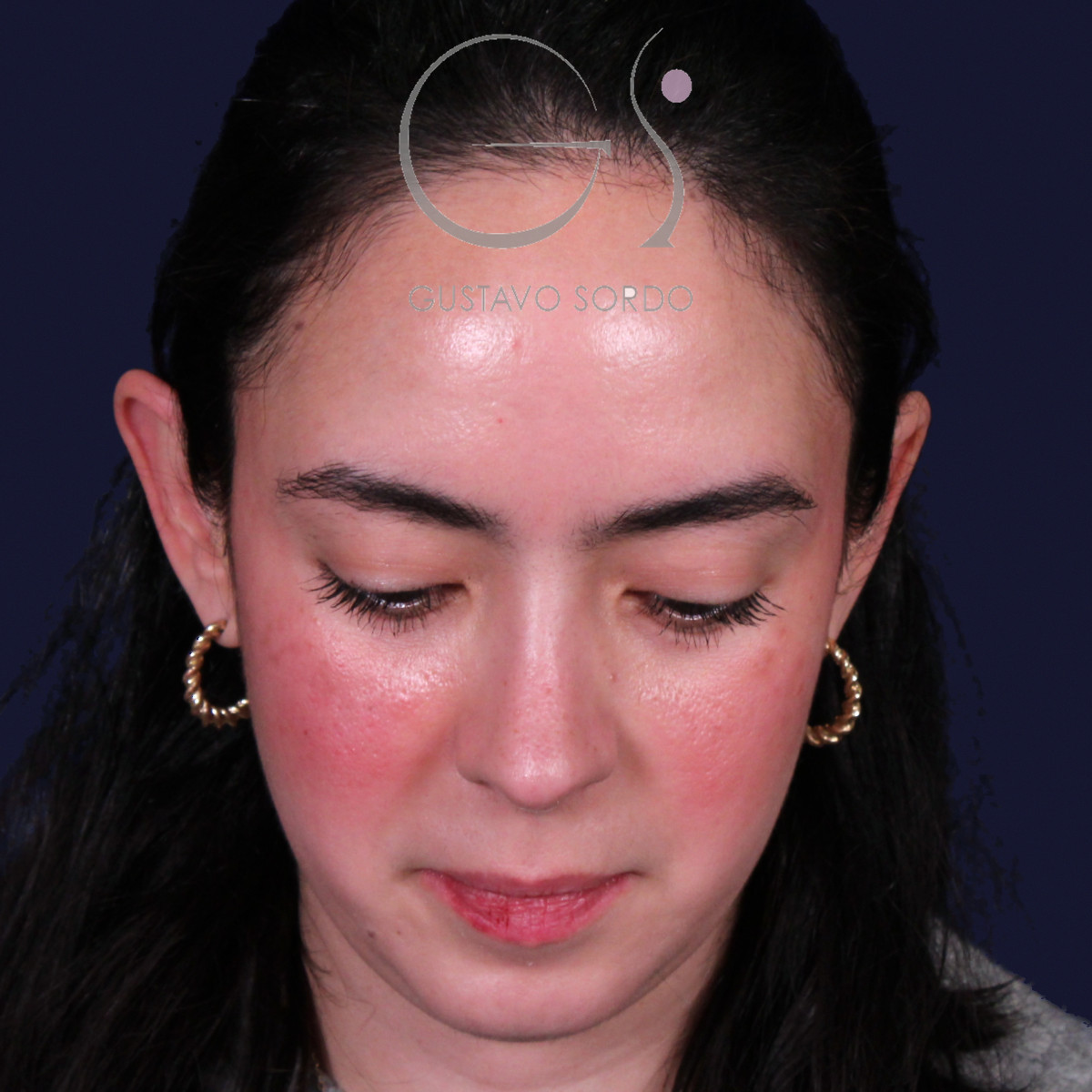 Rinoplastia estructural en piel gruesa con punta gruesa, vista con el mentón abajo: resultado al año de la operación