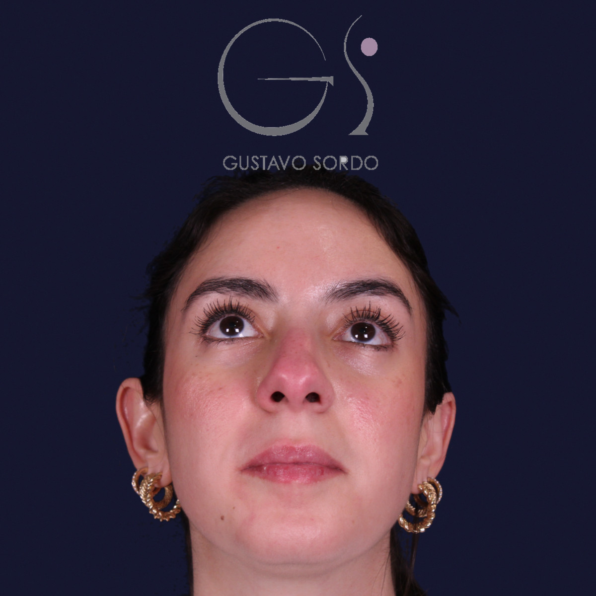 Rinoplastia estructural en piel gruesa con punta gruesa, vista con el mentón arriba: antes de la operación