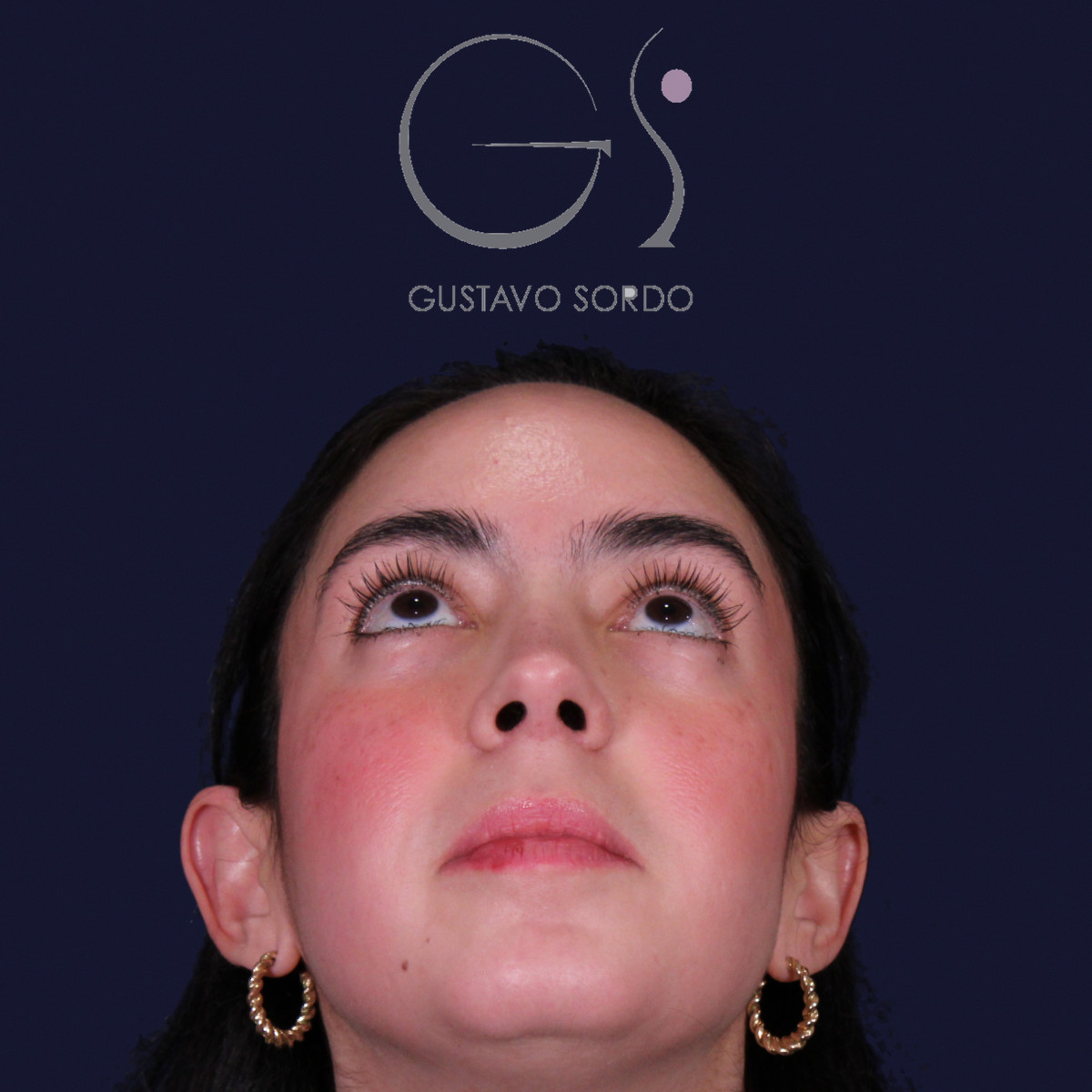 Rinoplastia estructural en piel gruesa con punta gruesa, vista con el mentón arriba: resultado al año de la operación