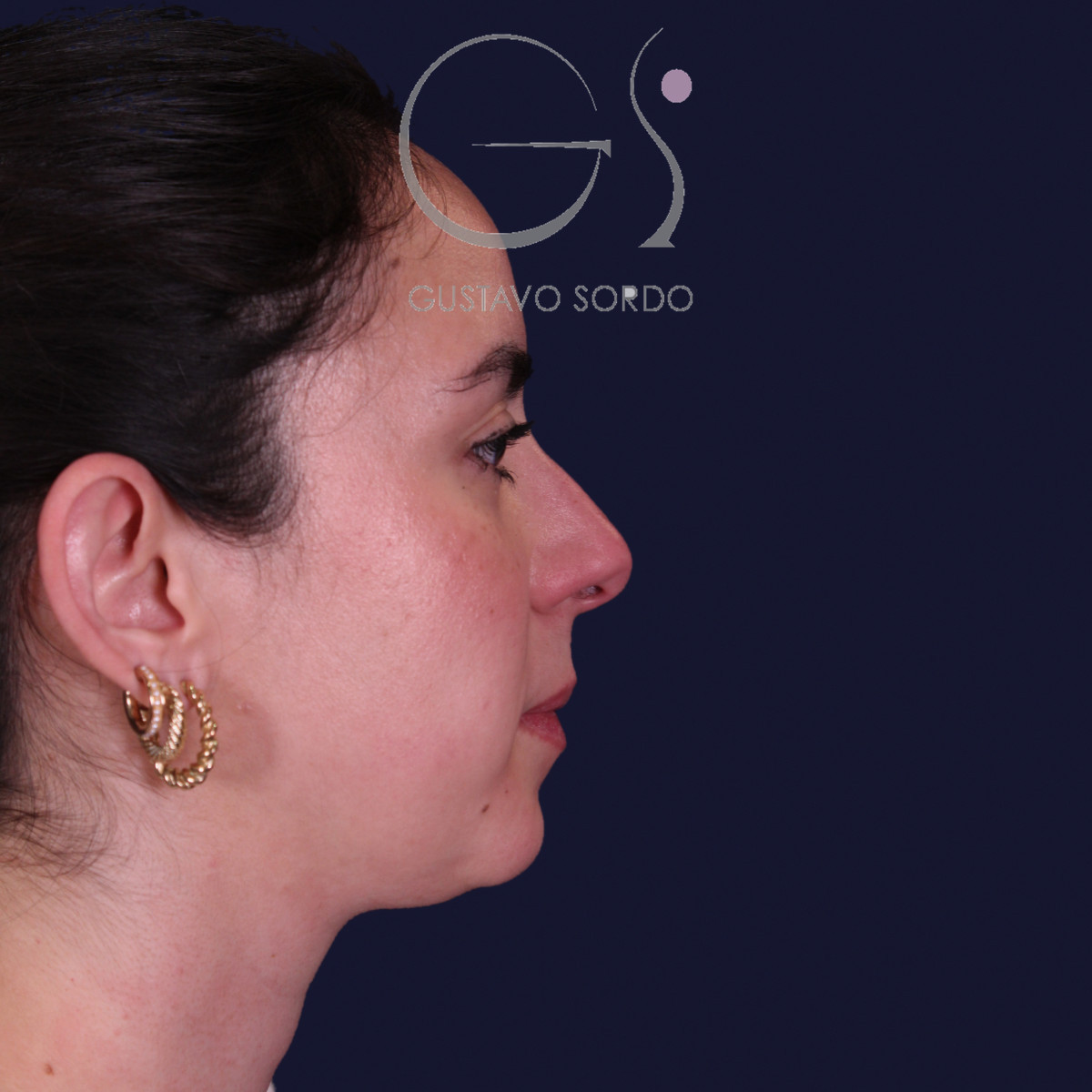Antes de rinoplastia, Dr. Gustavo Sordo