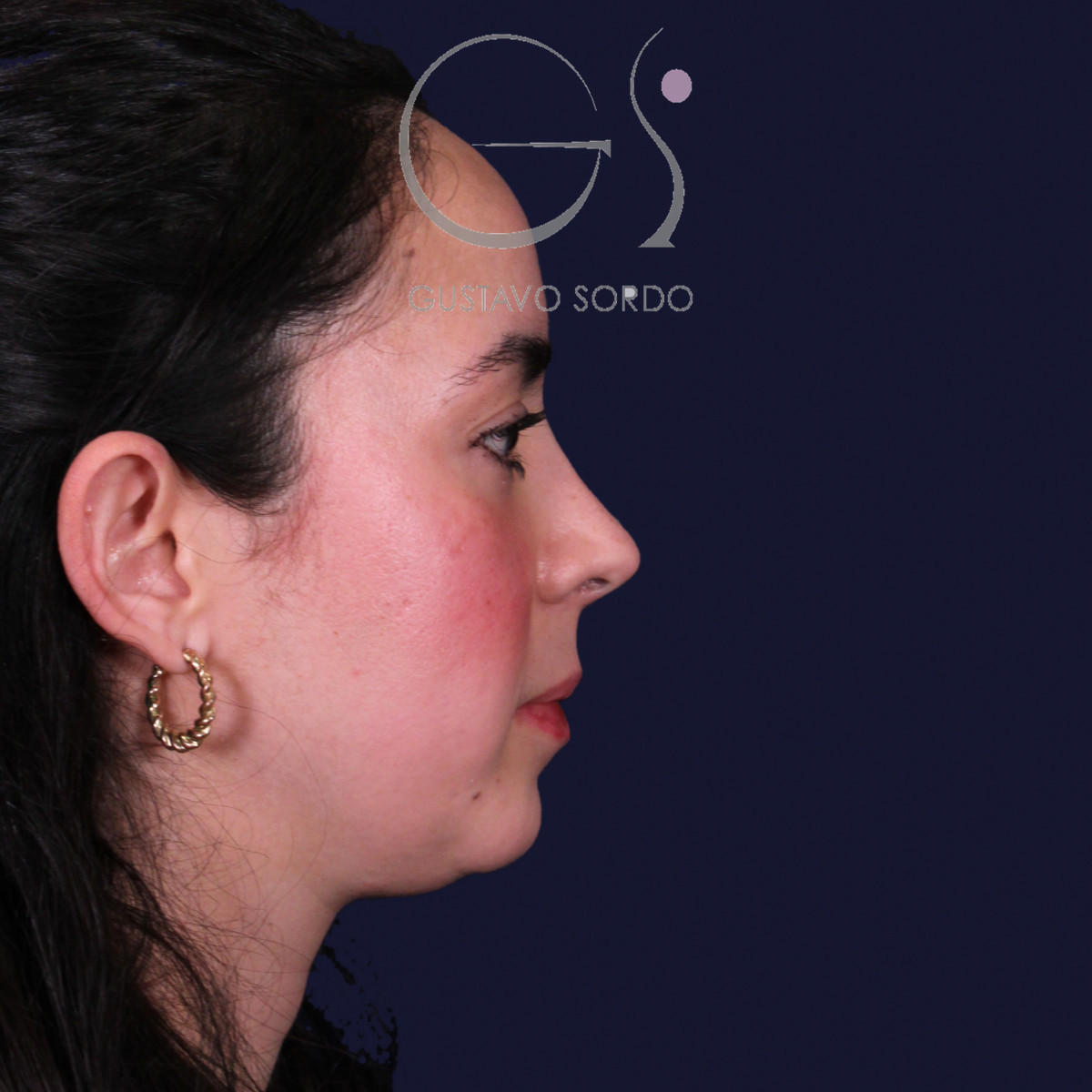 Después de rinoplastia, Dr. Gustavo Sordo