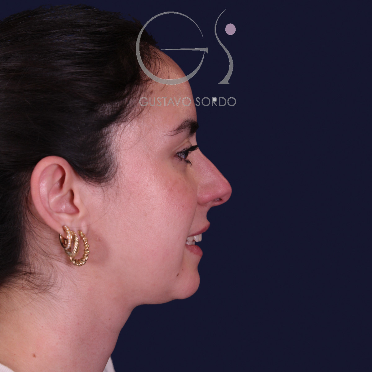 Rinoplastia estructural en piel gruesa con punta gruesa, perfil derecho sonriendo: antes de la operación