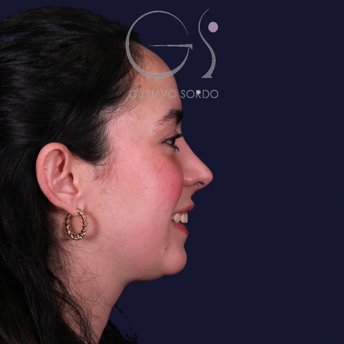 Rinoplastia estructural en piel gruesa con punta gruesa, perfil derecho sonriendo: resultado al año de la operación