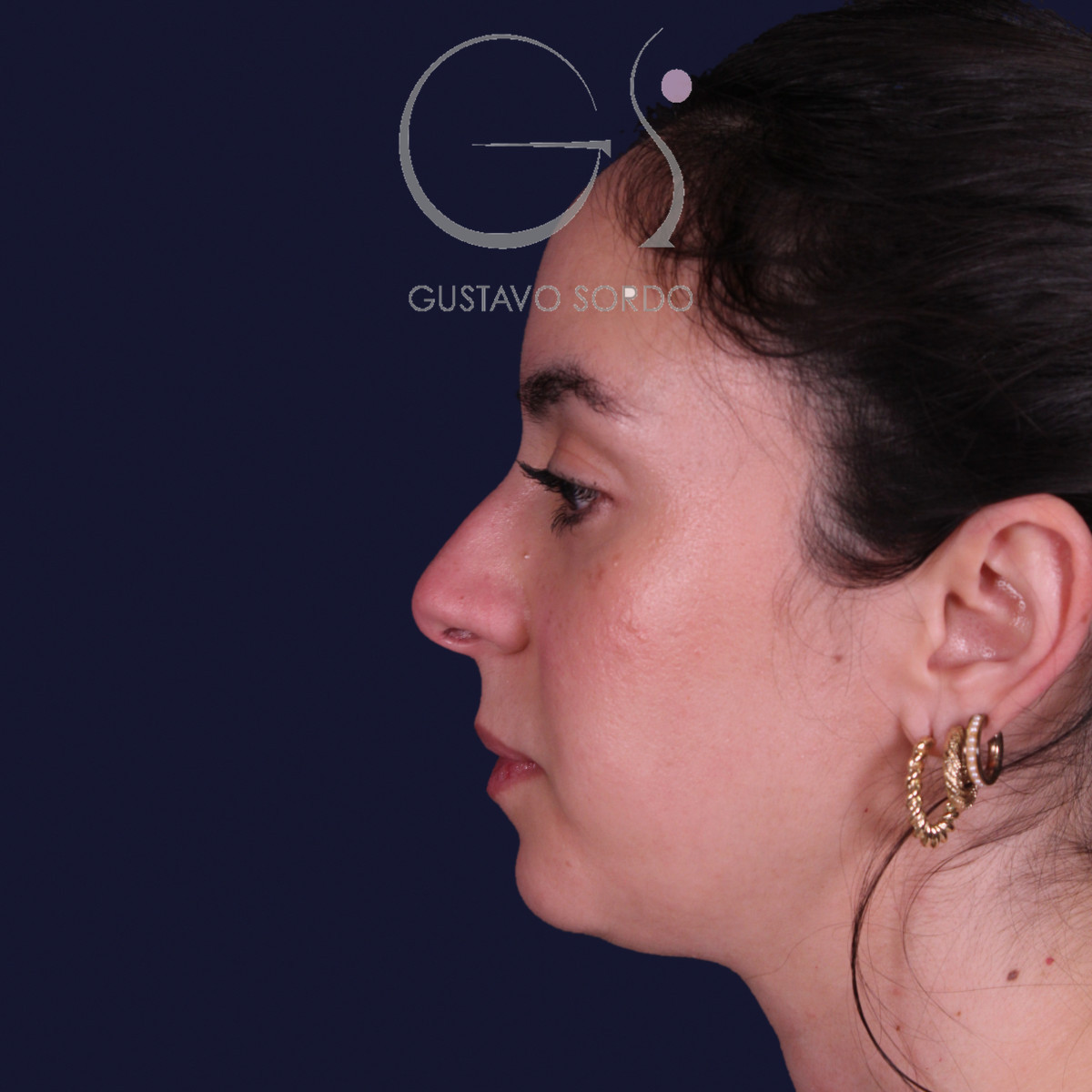 Rinoplastia estructural en piel gruesa con punta gruesa, perfil izquierdo: antes de la operación