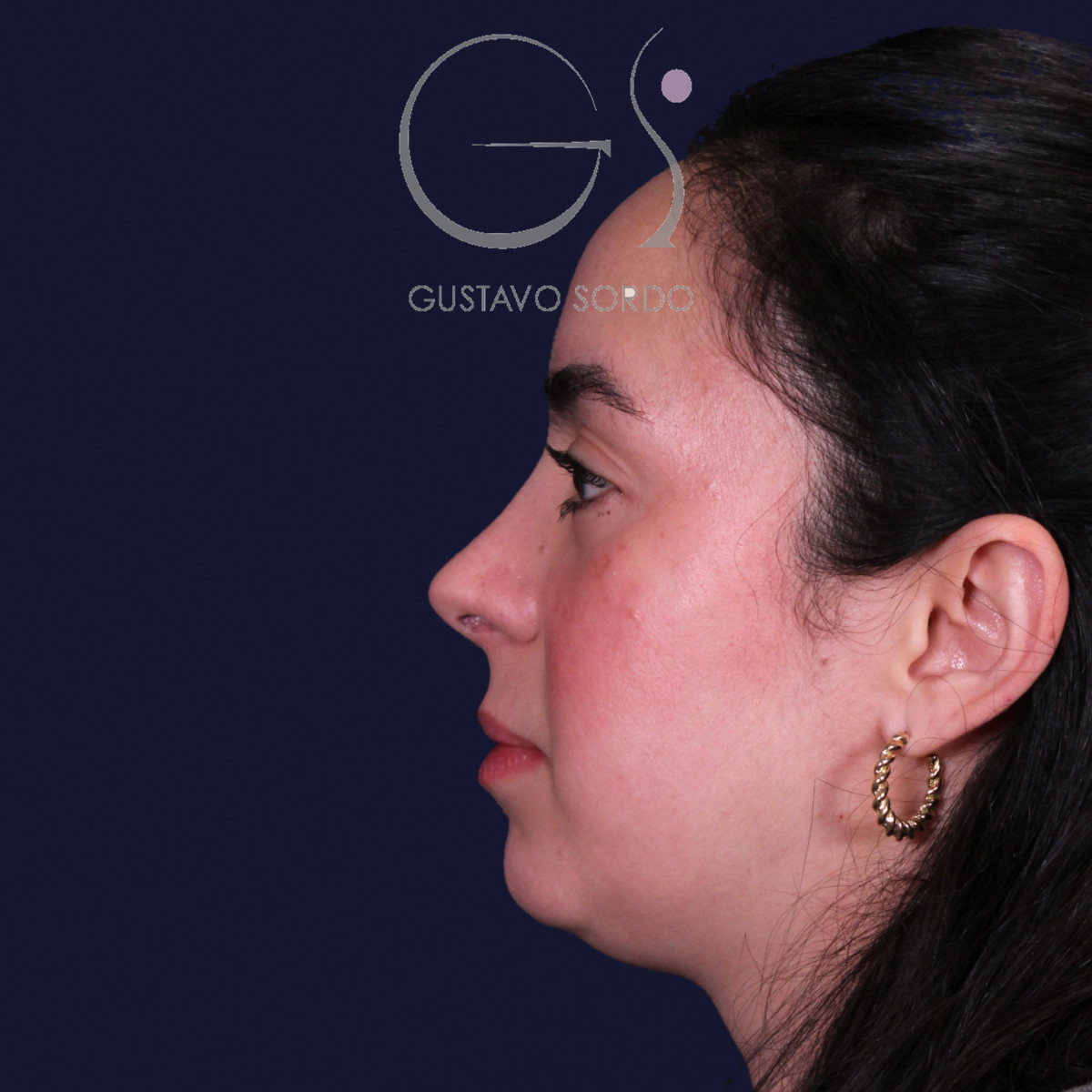 Rinoplastia estructural en piel gruesa con punta gruesa, perfil izquierdo: resultado al año de la operación