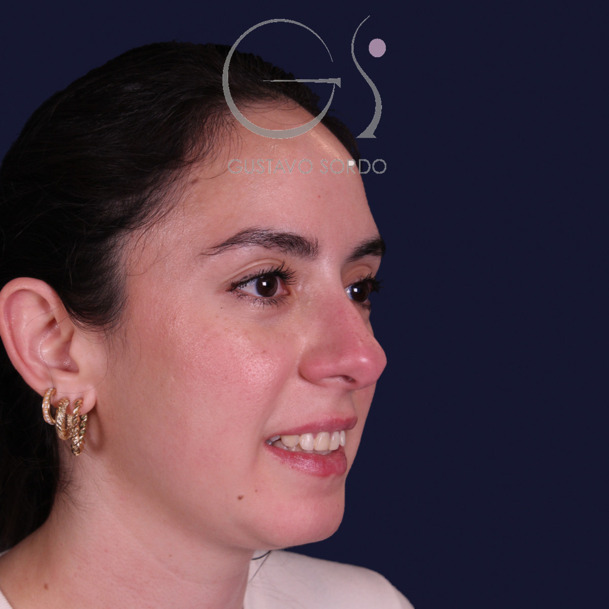 Rinoplastia estructural en piel gruesa con punta gruesa, semiperfil derecho: antes de la operación