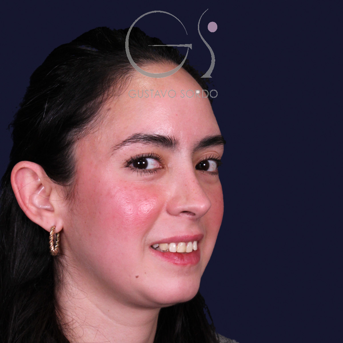 Rinoplastia estructural en piel gruesa con punta gruesa, semiperfil derecho: resultado al año de la operación