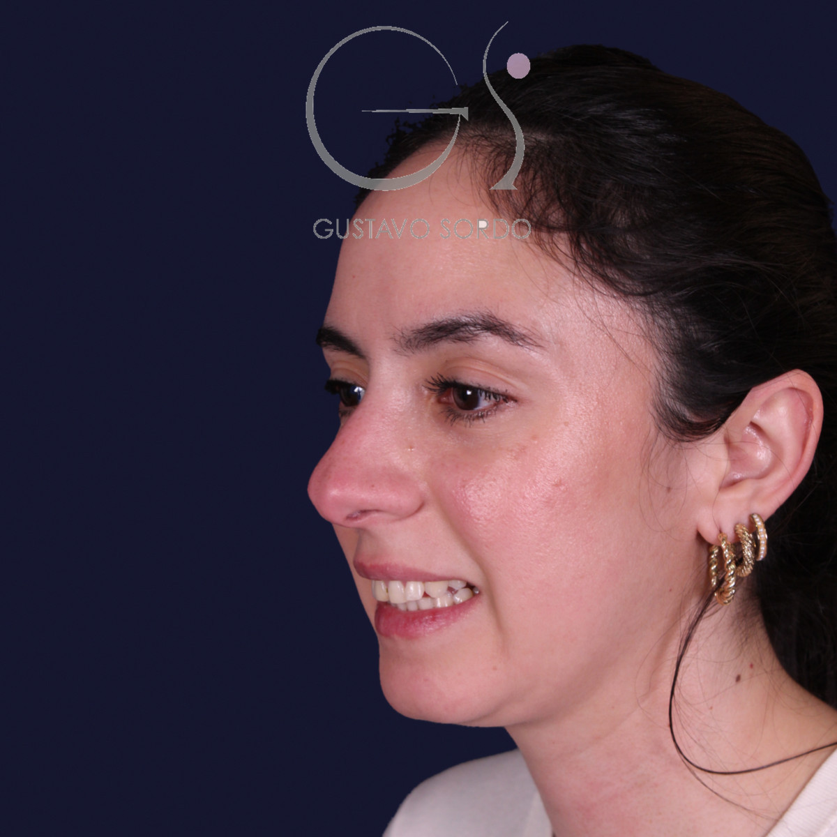 Rinoplastia estructural en piel gruesa con punta gruesa, semiperfil izquierdo: antes de la operación