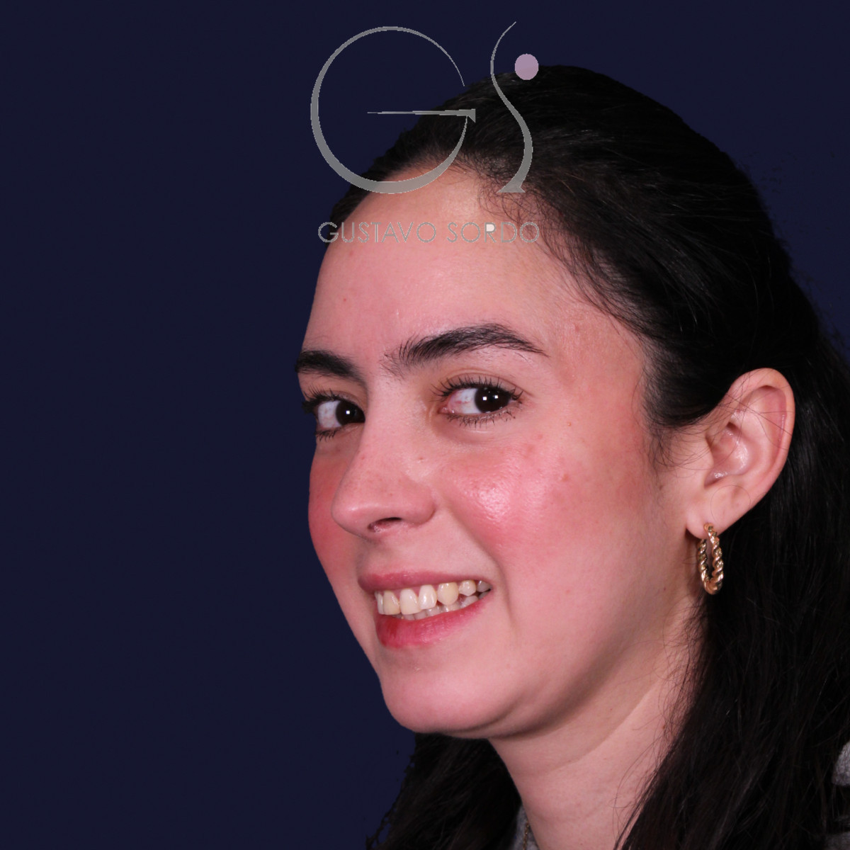 Rinoplastia estructural en piel gruesa con punta gruesa, semiperfil izquierdo: resultado al año de la operación