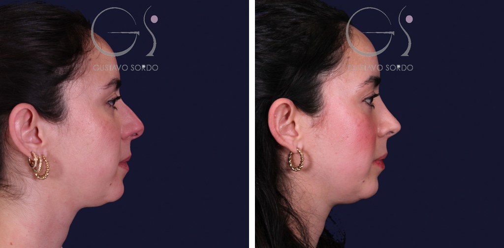 Rinoplastia estructural en piel gruesa y punta gruesa: antes y después de un caso operado en Madrid