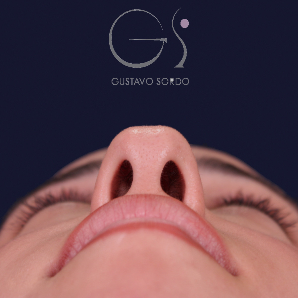 Rinoplastia de preservación con mentoplastia, vista basal: antes de la operación
