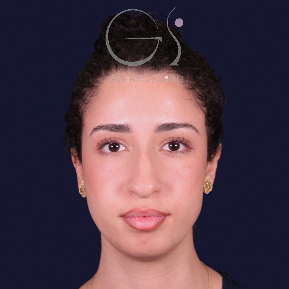 Rinoplastia de preservación con mentoplastia, vista frontal: antes de la operación