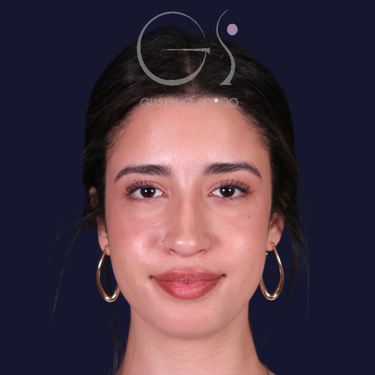 Rinoplastia de preservación con mentoplastia, vista frontal: resultado al año de la operación